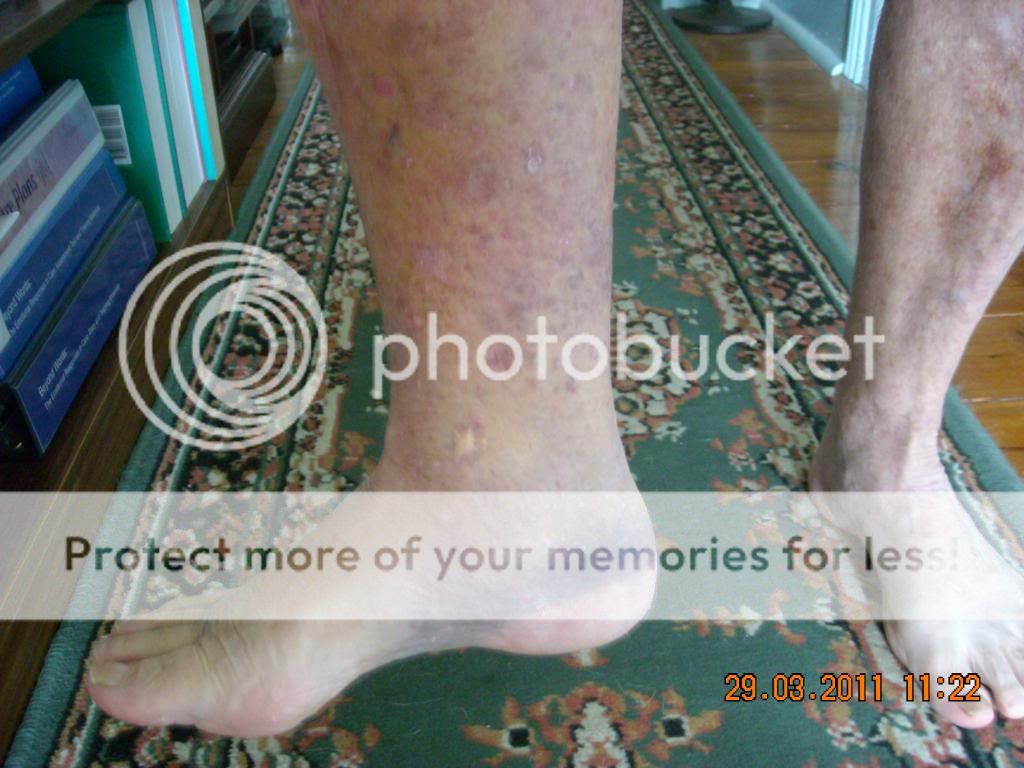 Tok Tok place Images from my knee replacement